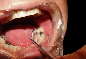の 匂い 虫歯 虫歯で口臭が発生しやすくなる6つの理由と効果的な口臭対策